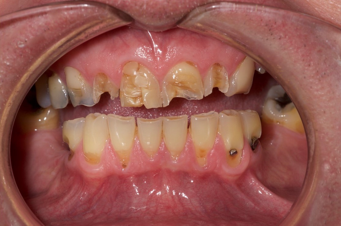 Cosmetic Bonding Halifax, NS Dr. Jenine Arab Omalley